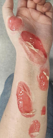 Chemical Burns